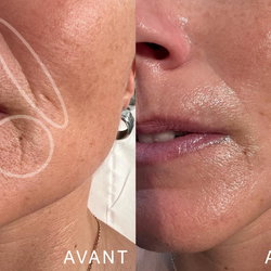 Laser Visage Vit C + Collagène + Plasma + EGF / les 5 séances à 1000 CHF