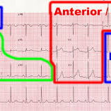 ECG