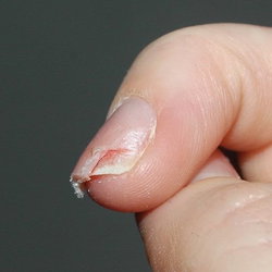 Réparation 1 ongle